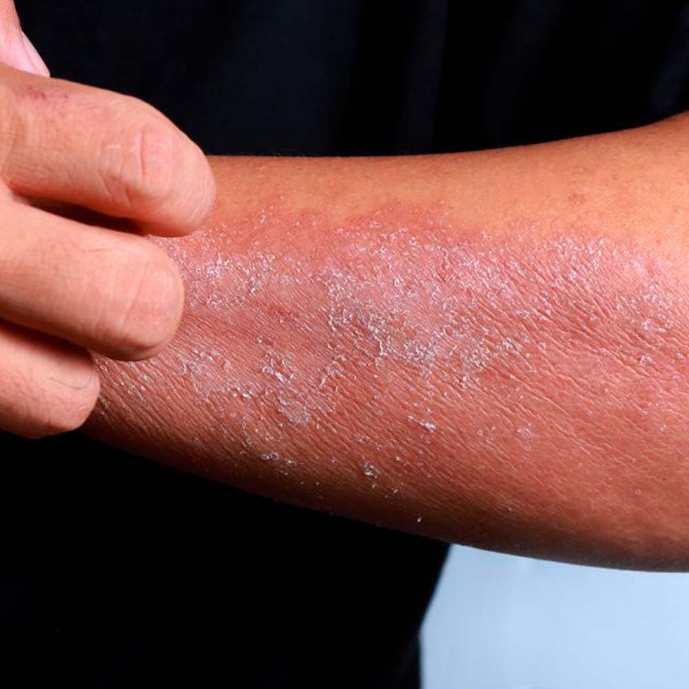 Pack 10 Jabón Natural De Laurel - Para Piel Grasa, Con Acné - Regula El Exceso De Grasa - Alivia Irritaciones Y Picores_3