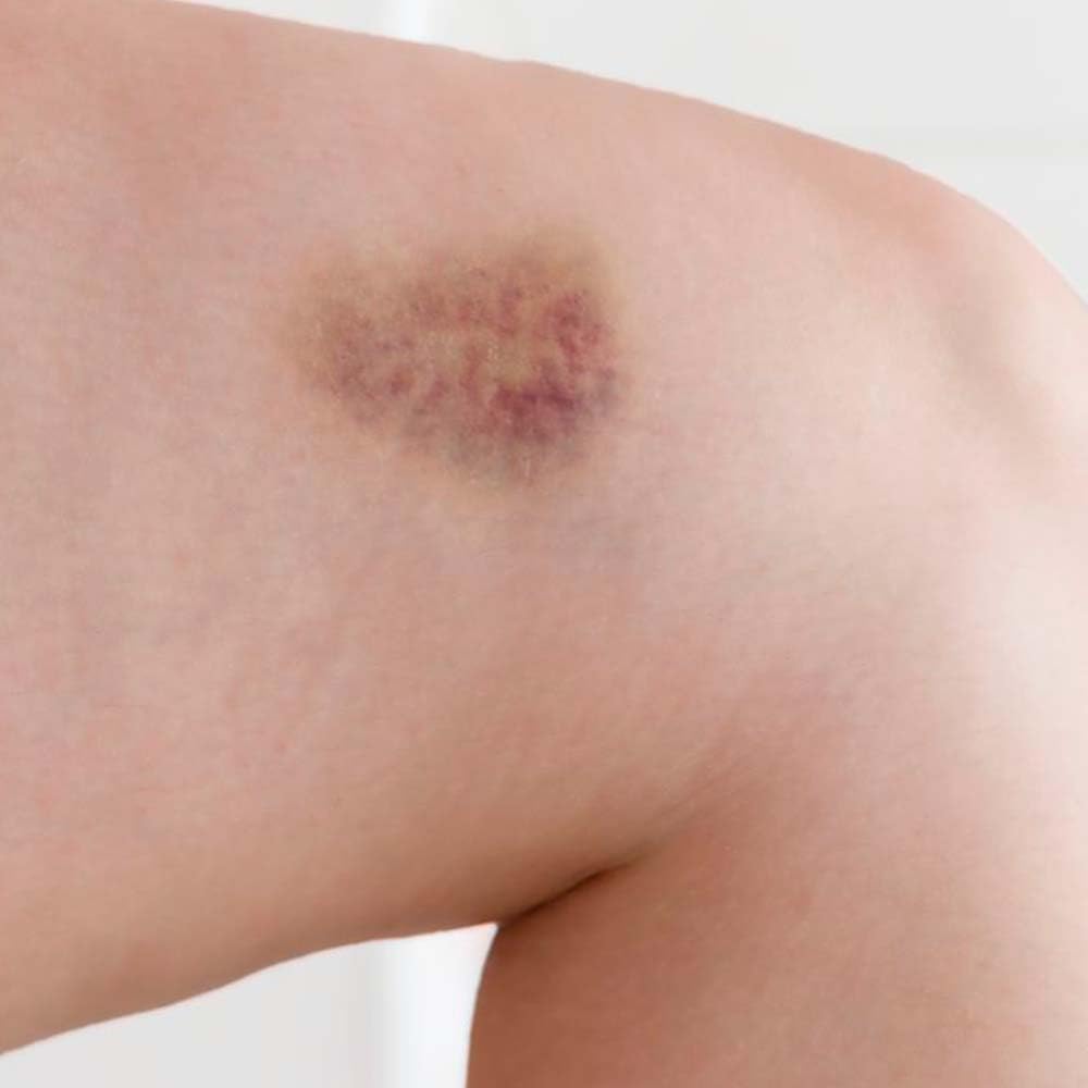 Pack 5 Jabón Natural De Árnica - Mejora Las Varices Y Hematomas - Alivia Las Piernas Cansadas - Cara Y Cuerpo_5