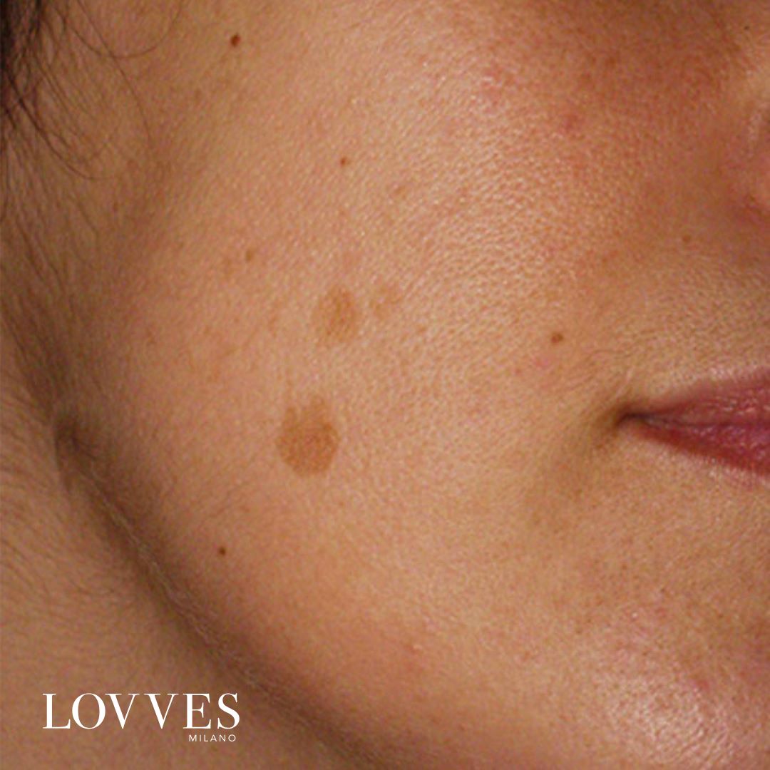 Lovves Sérum Aclarante Manchas Faciales Despigmentante 30ml_3