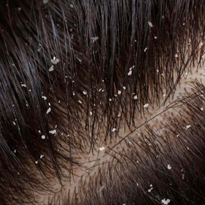 Pack 2 Champú Sólido Anticaspa - 100% Natural - Con Brea - Elimina Caspa Y Alivia Los Picores. Hecho En España_2