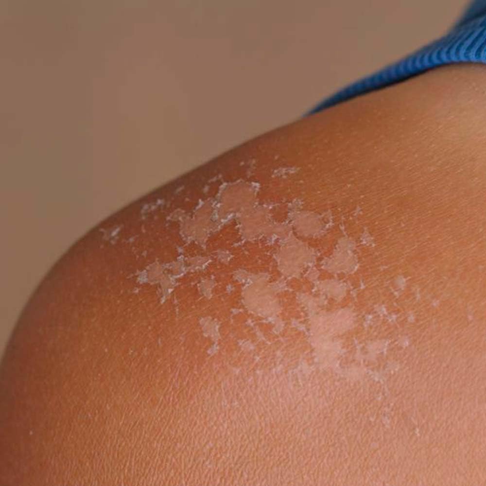 Pack 5 Jabón Natural De Caléndula - Calma La Piel Seca, Con Dermatitis E Irritaciones - Cicatriza Y Alivia Quemaduras_3
