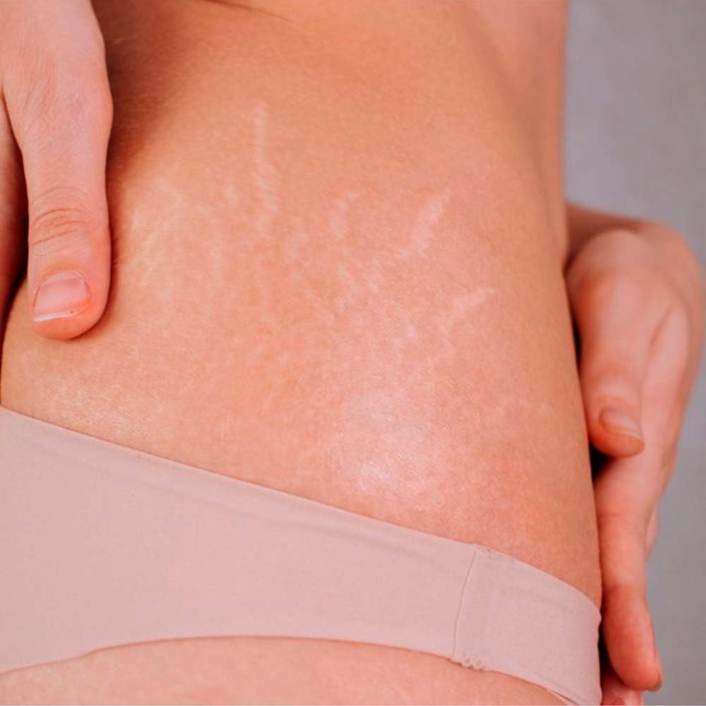 Pack 5 Jabón Natural Rosa Mosqueta - Para Todo Tipo De Piel - Hidrata Y Regenera Pieles Con Estrías, Manchas, Cicatrices_5